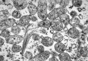 F,27y. | oncocytoma - kidney